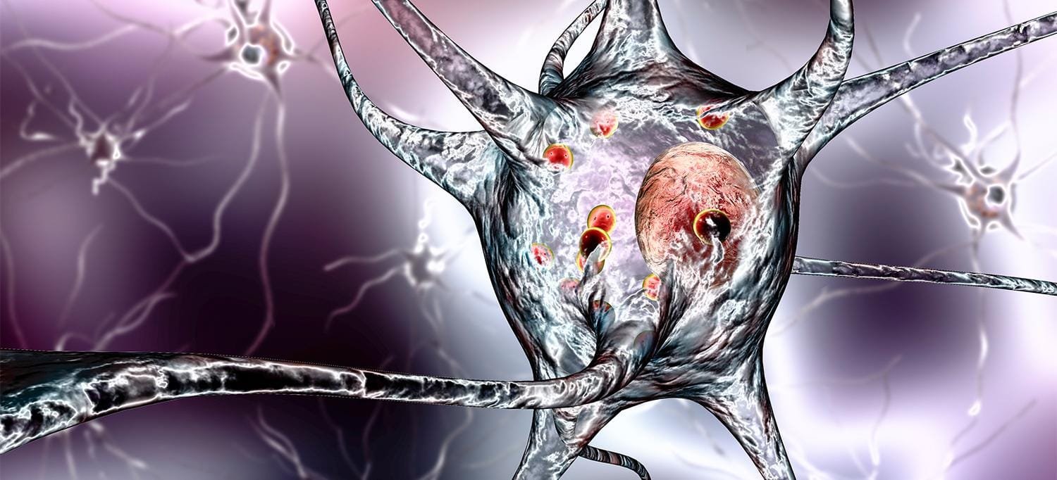 China’s Breakthrough in Blocking Parkinson's Disease 1 Parkinson's Disease